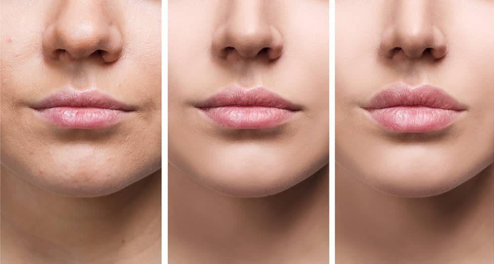 Dermal fillers used on womans lips. Before and after picture.